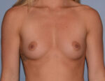 Breast Augmentation Implants