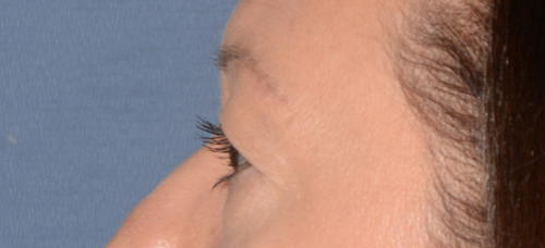 Eyelid Lift