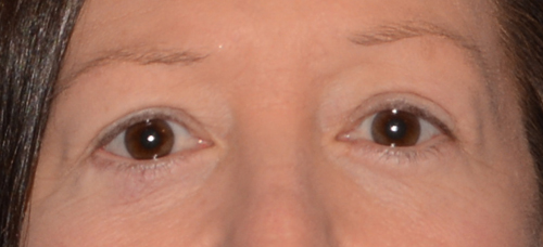Eyelid Lift
