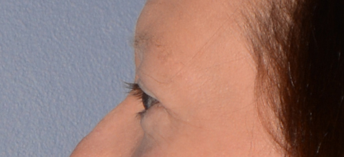 Eyelid Lift