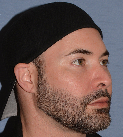 Buccal Fat Removal