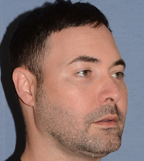 Buccal Fat Removal