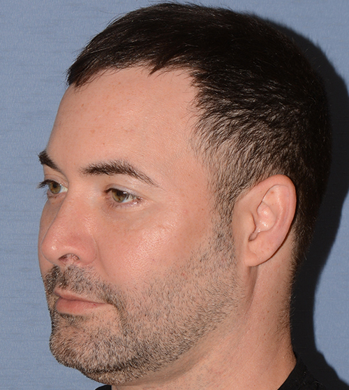 Buccal Fat Removal