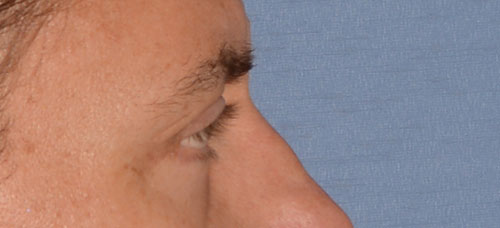 Eyelid lift