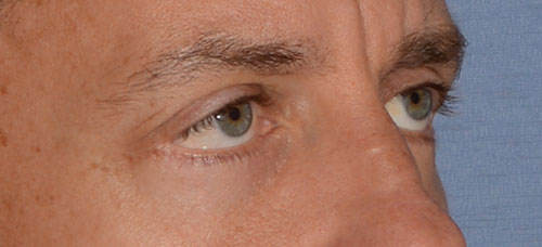 Eyelid Lift