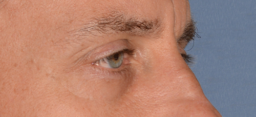 Eyelid Lift