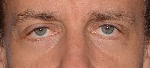 Eyelid Lift