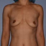 Breast Augmentation Implants