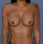 Breast Augmentation Implants