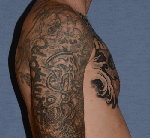 Pectoral Chest Implants