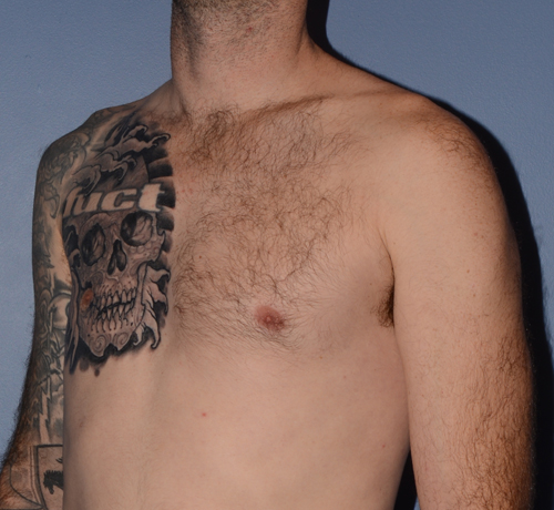 Pectoral Chest Implants