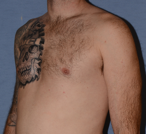 Pectoral Chest Implants