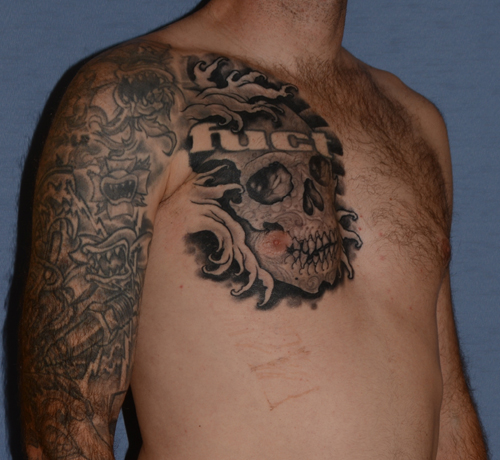 Pectoral Chest Implants