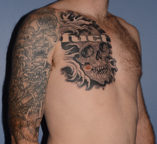 Pectoral Chest Implants