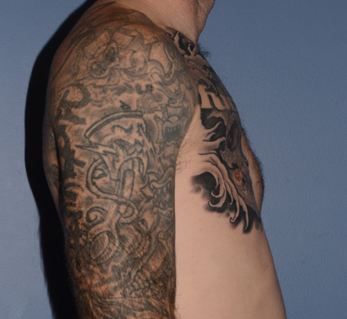 Pectoral Chest Implants