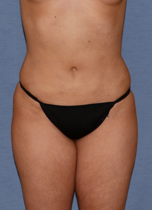 Liposuction