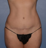 Liposuction