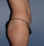 Liposuction