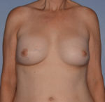 Breast Correction