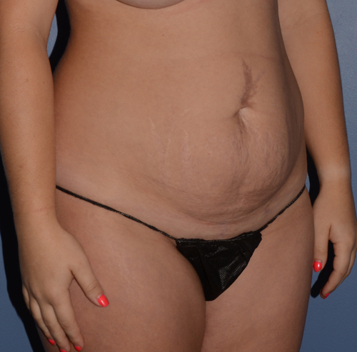 Tummy Tuck