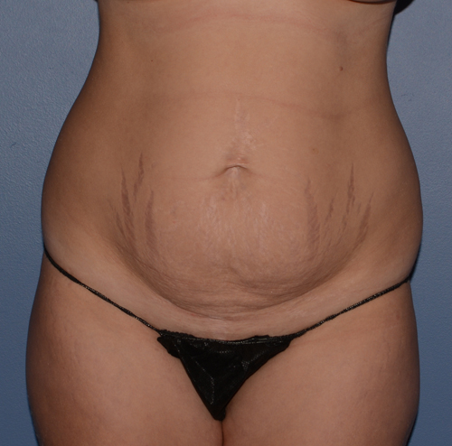 Tummy Tuck