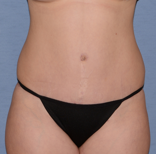 Tummy Tuck