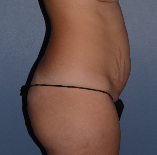 Tummy Tuck