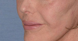 Lip Implant