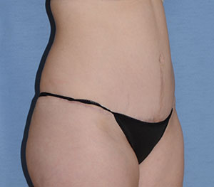 Tummy Tuck