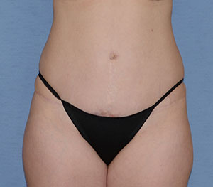 Tummy Tuck