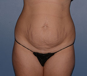 Tummy Tuck