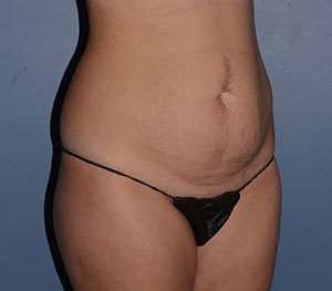 Tummy Tuck