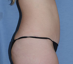 Tummy Tuck