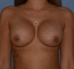 Breast Augmentation Implants