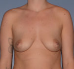 Breast Augmentation Implants