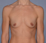 Breast Augmentation Implants