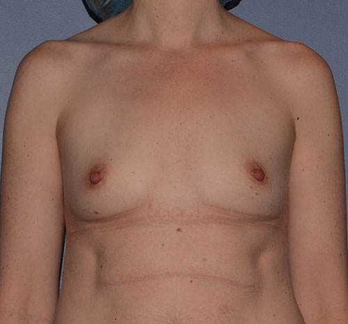 Breast Augmentation Implants