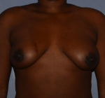 Breast Augmentation Implants