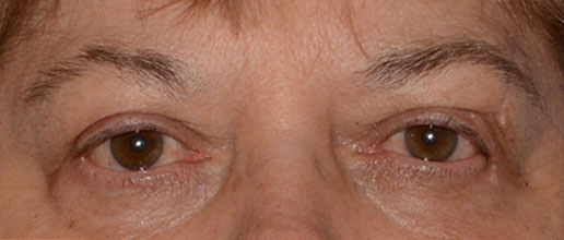 Eyelid Lift