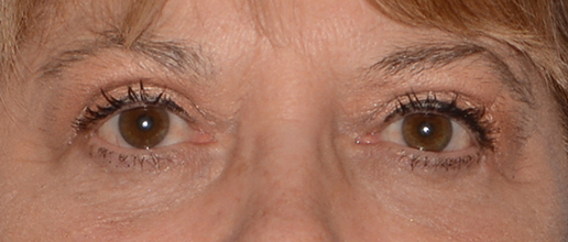 Eyelid Lift