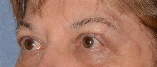 Eyelid Lift