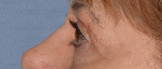 Eyelid Lift