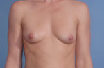 Breast Augmentation Implants