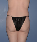 Liposuction