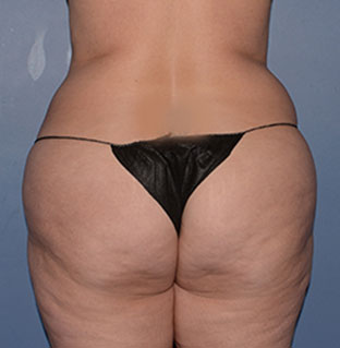 Liposuction