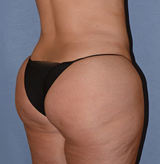 Liposuction