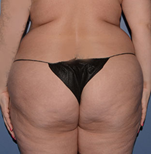 Liposuction