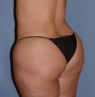 Liposuction