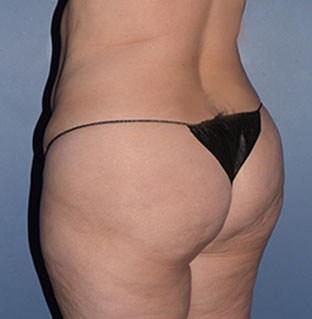 Liposuction