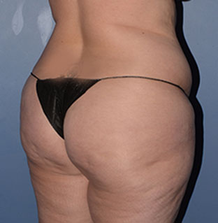 Liposuction